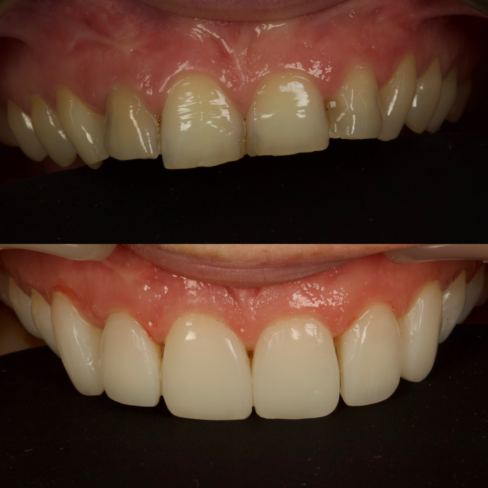 Bonding 1 Cosmetic Dentistry 10