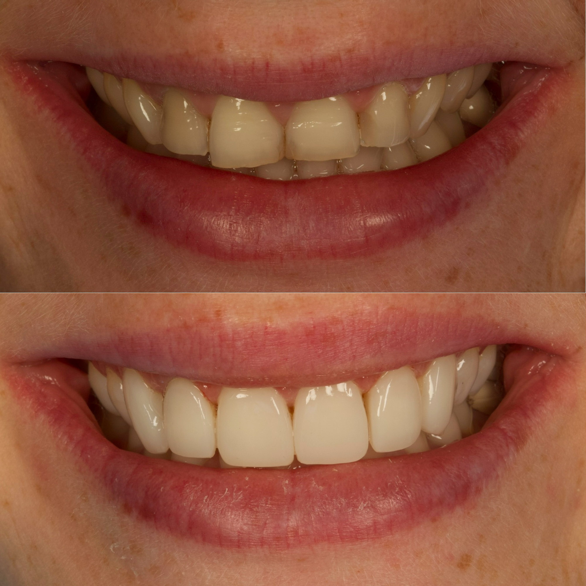 Bonding 2 Cosmetic Dentistry 8