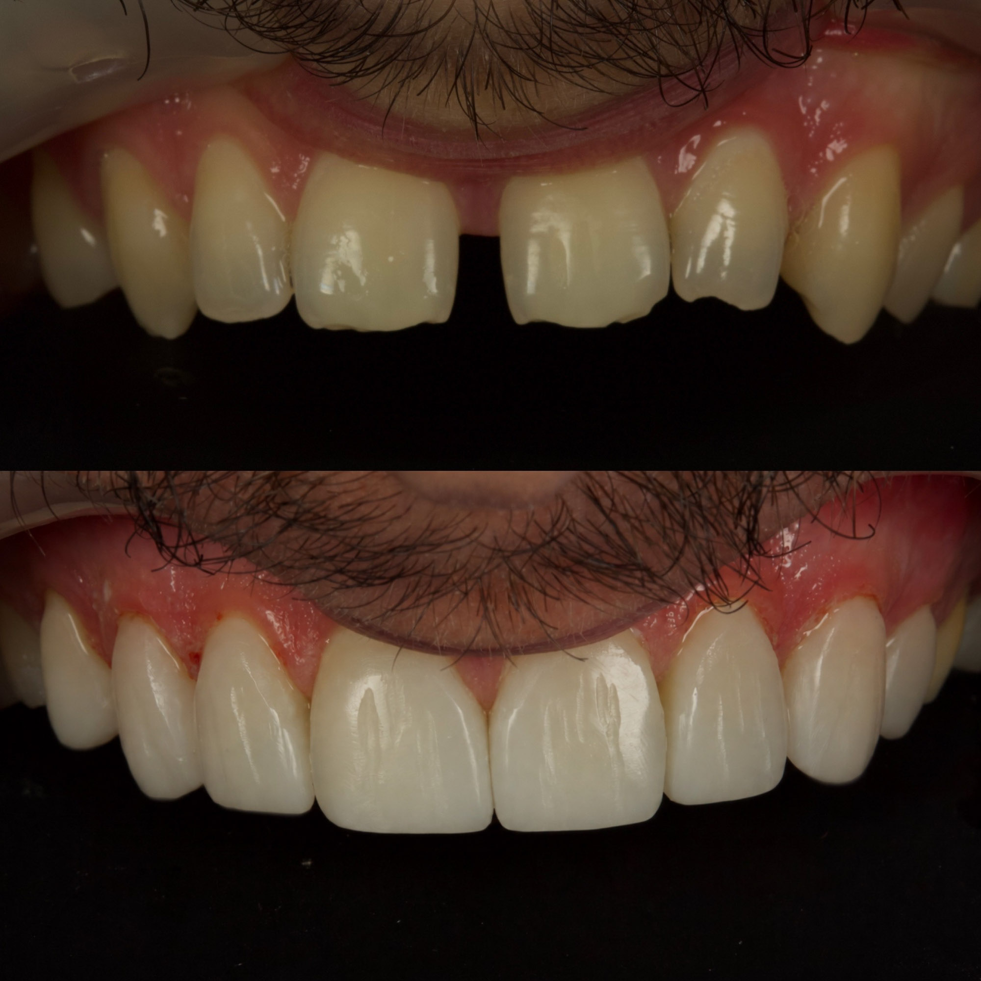 Bonding 3 Cosmetic Dentistry 9