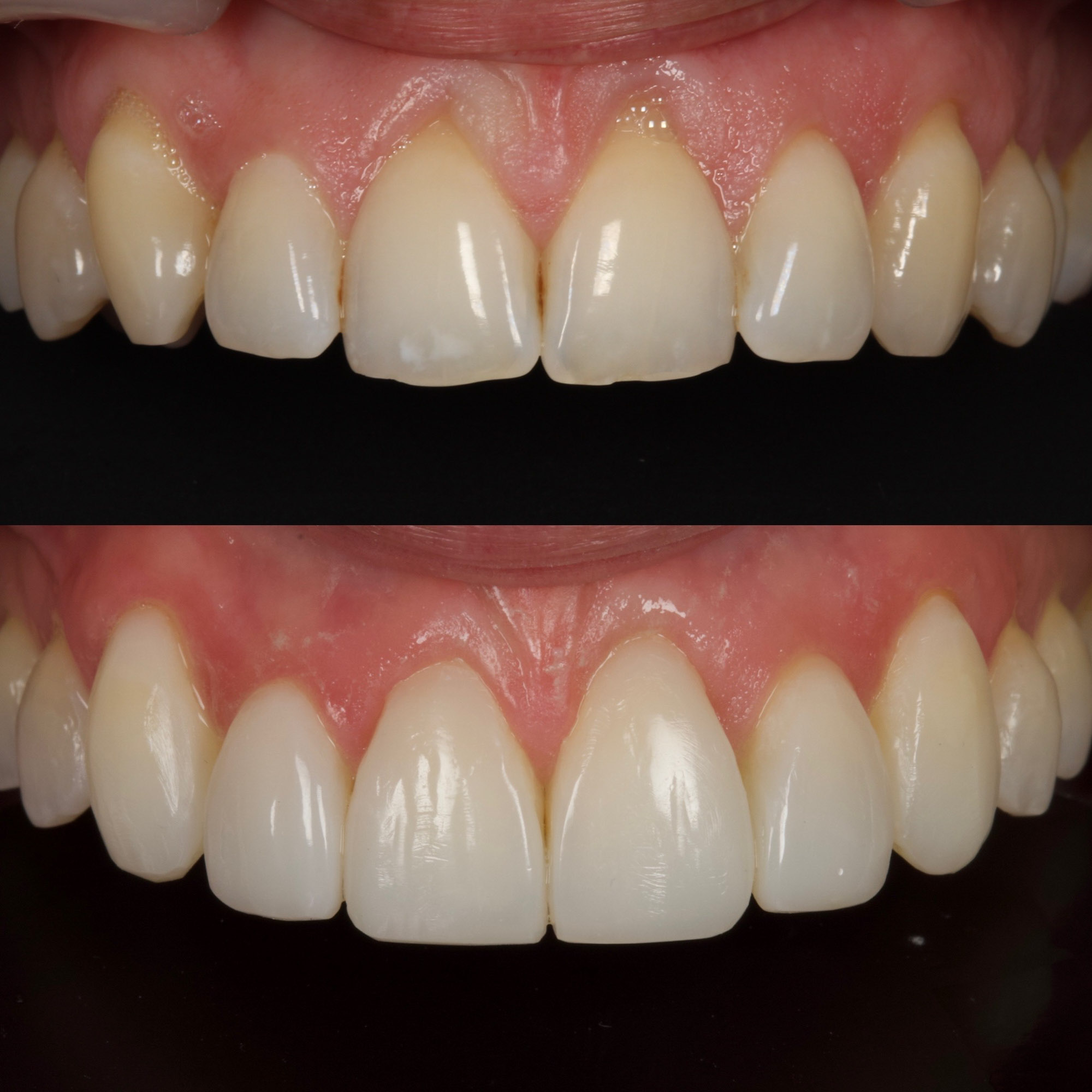 Bonding 4 Cosmetic Dentistry 5