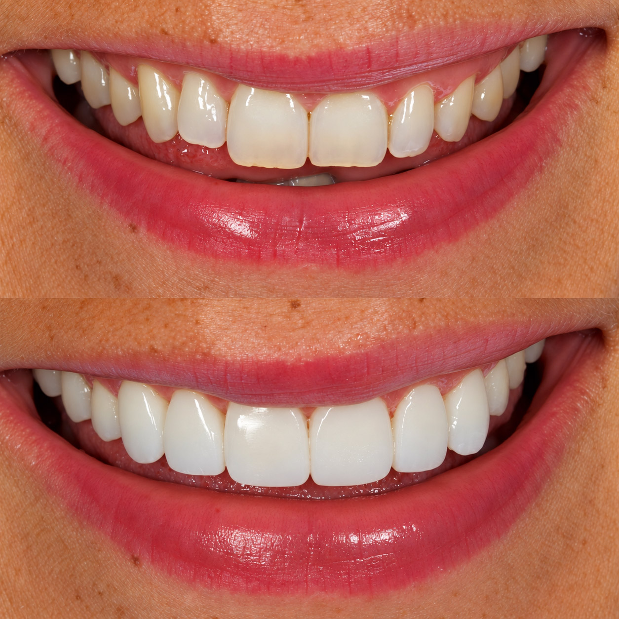 Bonding 5 Cosmetic Dentistry 4