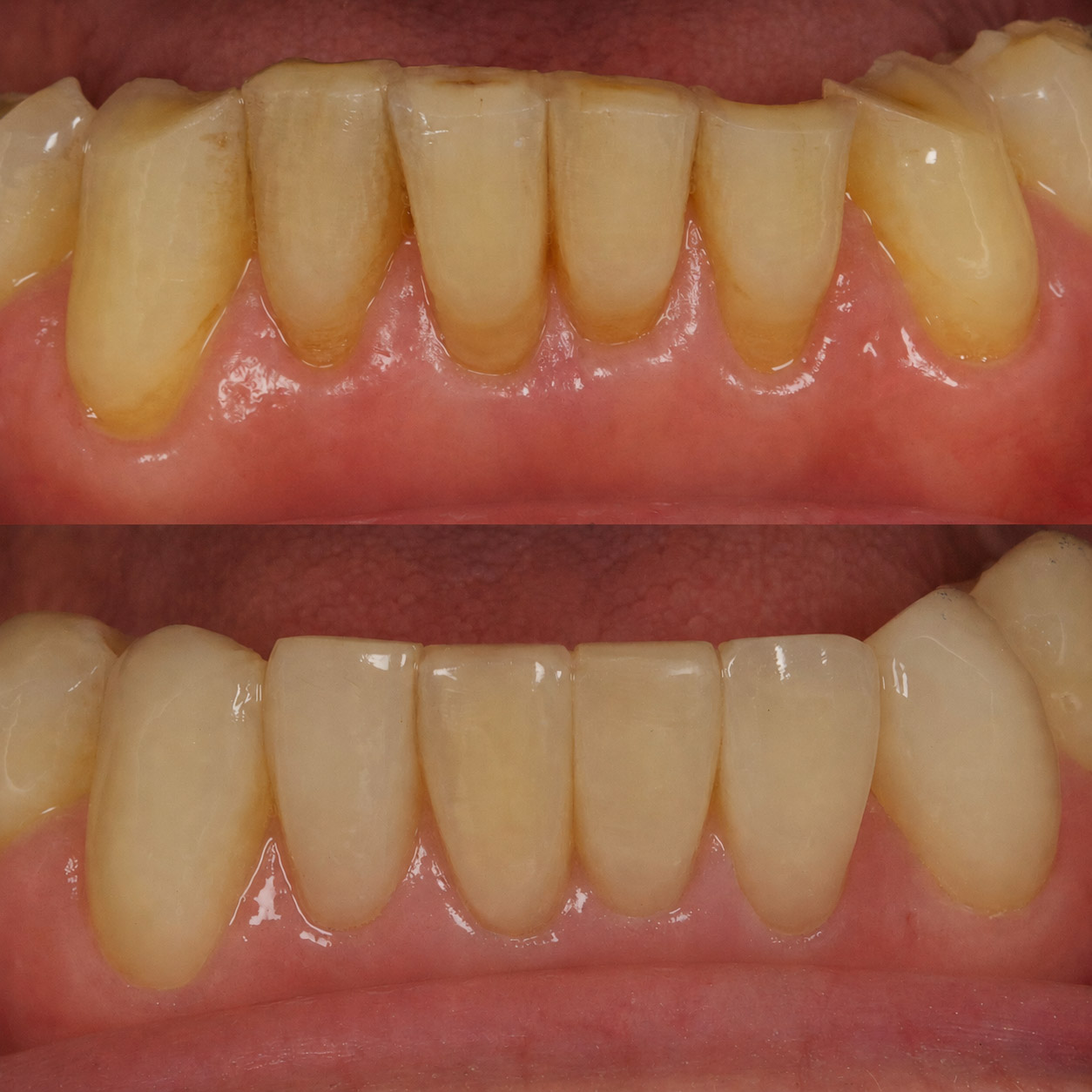 Bonding 6 Cosmetic Dentistry 7