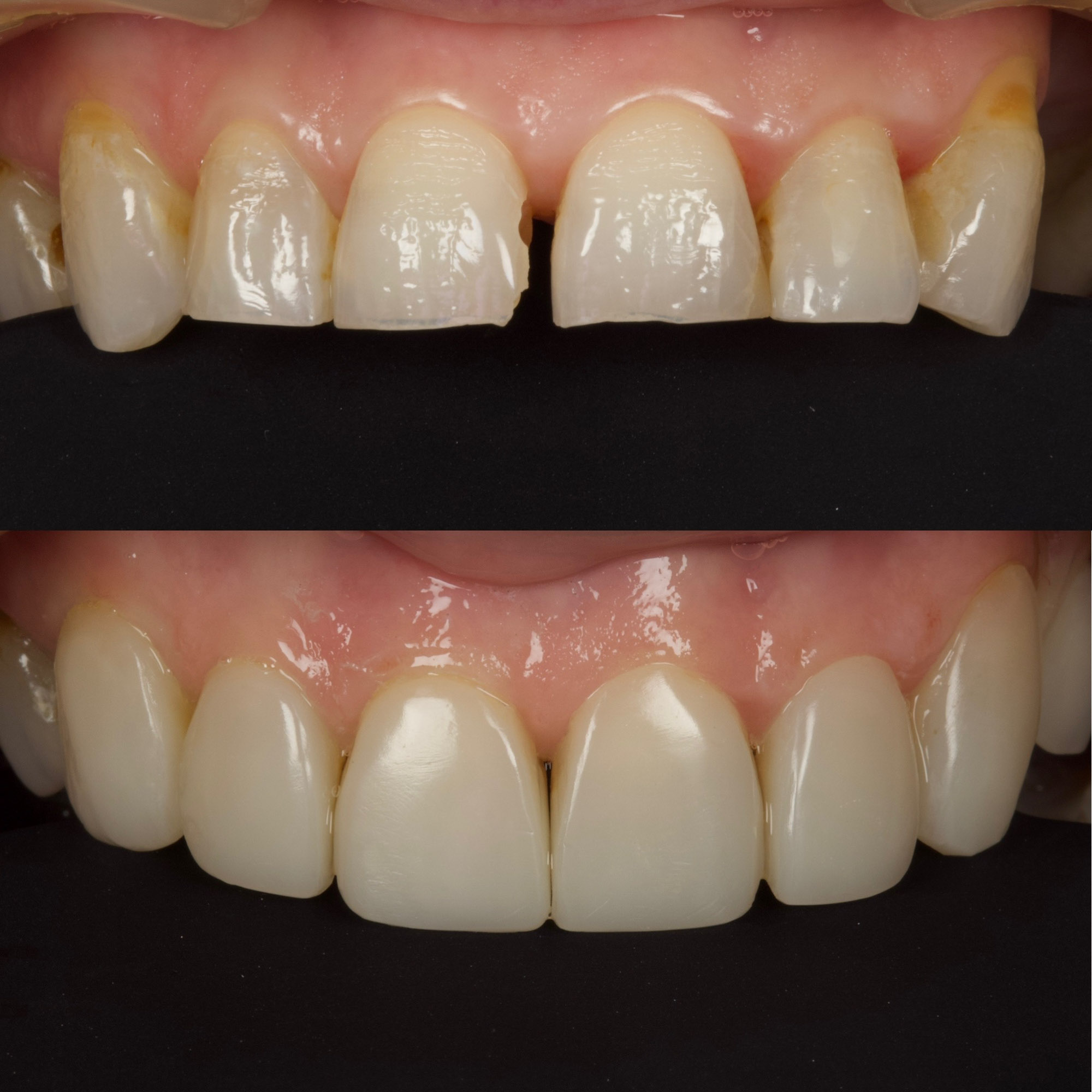 Bonding 7 Cosmetic Dentistry 6