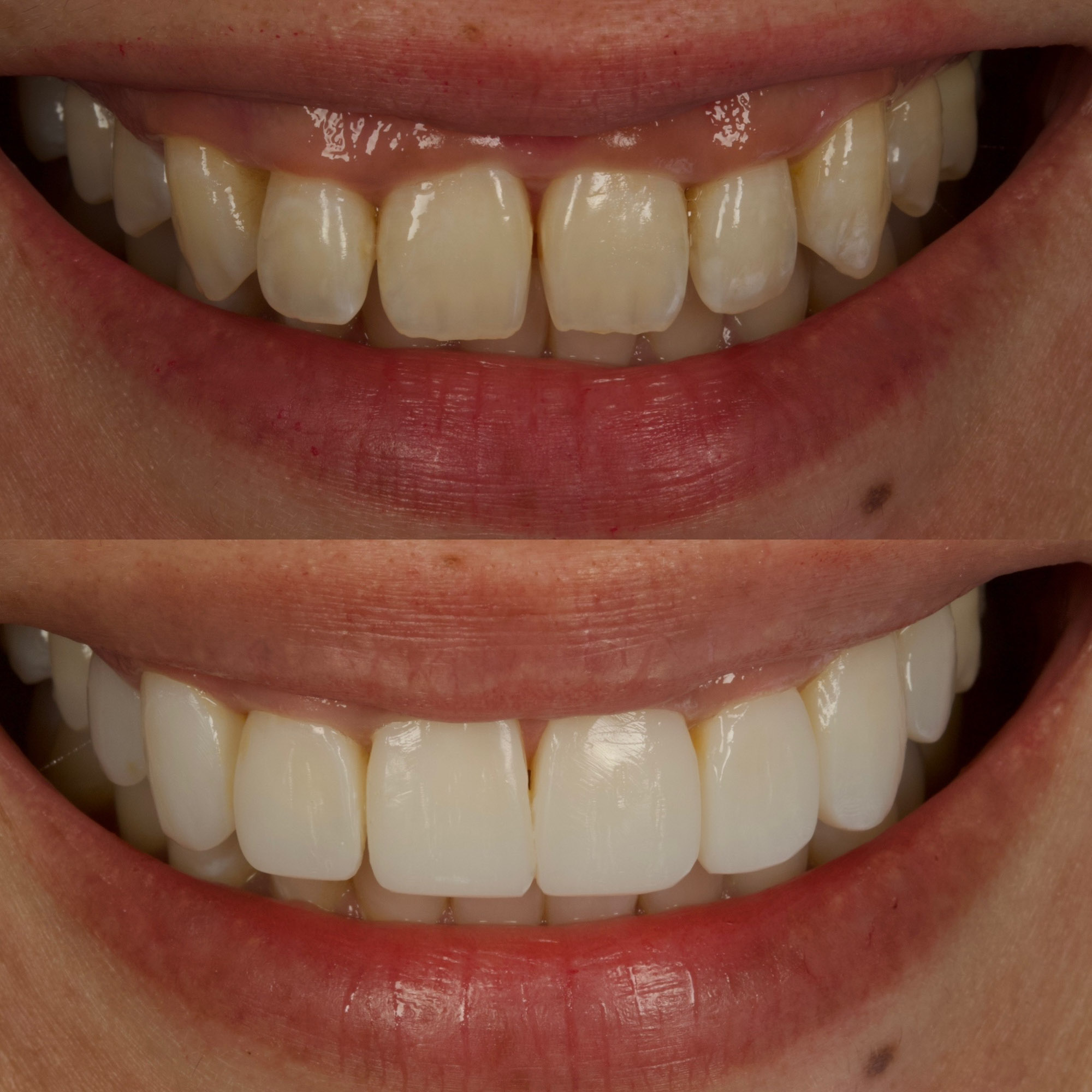 Bonding 8 Cosmetic Dentistry 3